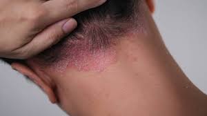 Scalp Psoriasis